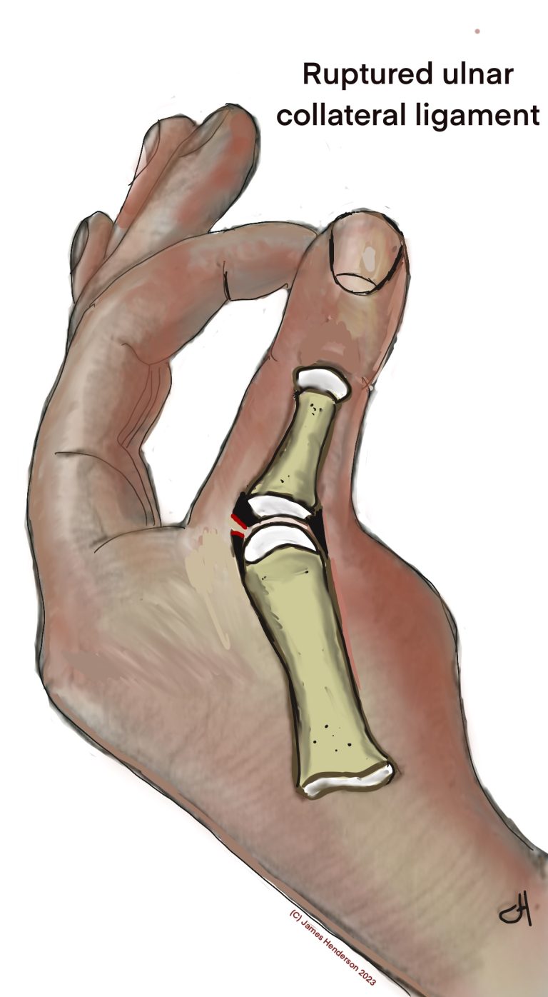 ruptured Ulnar collateral ligament of the thumb metacarpophalangeal