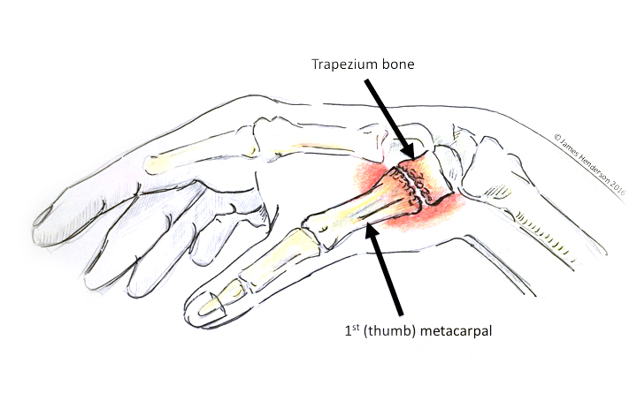 metacarpalis carpal artrosis